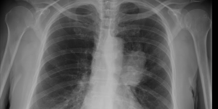 An x-ray of lungs.